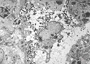 M,54y. | Whipple disease M,54y. | Whipple disease